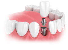 Single Implant